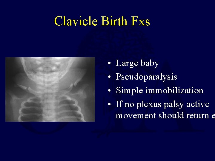 Clavicle Birth Fxs • • Large baby Pseudoparalysis Simple immobilization If no plexus palsy