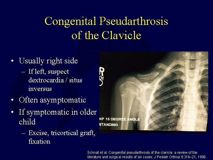 Congenital Pseudarthrosis of the Clavicle • Usually right side – If left, suspect dextrocardia