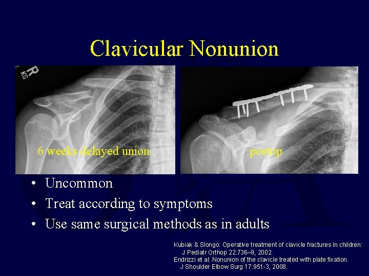 Clavicular Nonunion 6 weeks delayed union postop • Uncommon • Treat according to symptoms