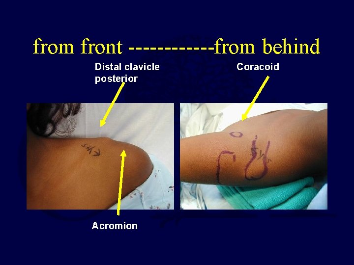 from front ------from behind Distal clavicle posterior Acromion Coracoid 