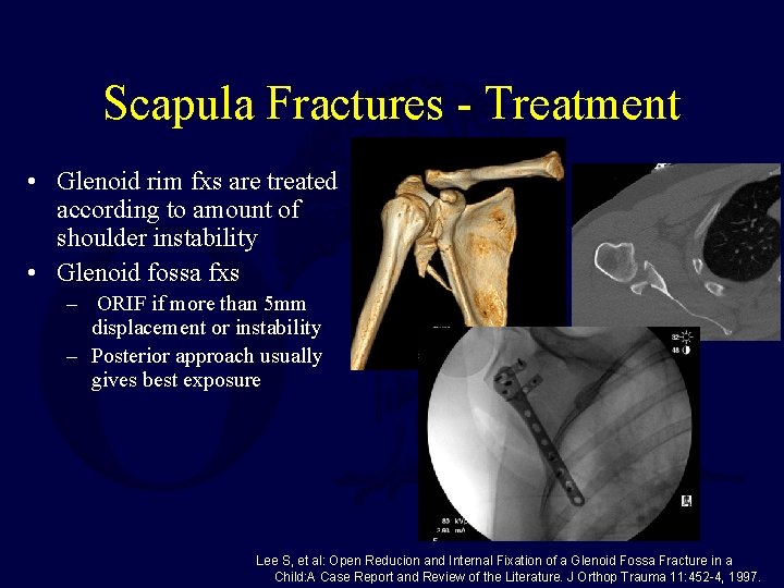 Scapula Fractures - Treatment • Glenoid rim fxs are treated according to amount of