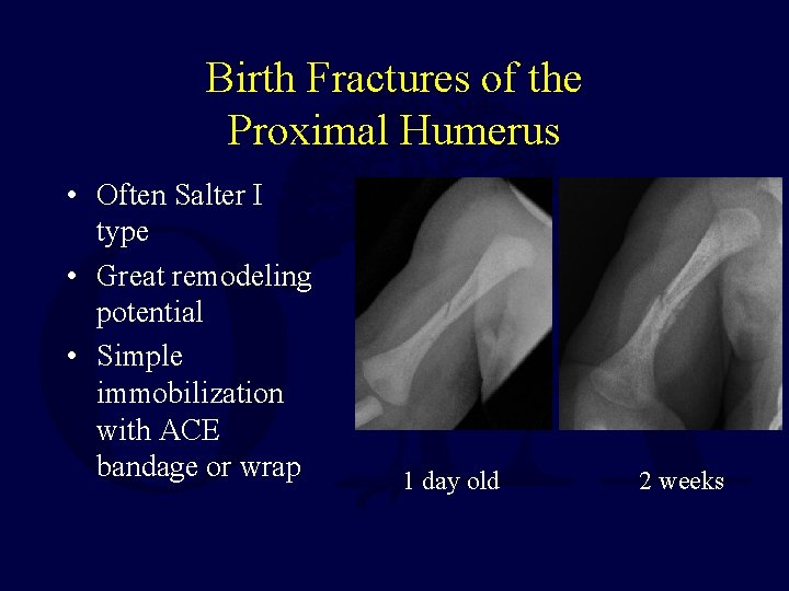 Birth Fractures of the Proximal Humerus • Often Salter I type • Great remodeling