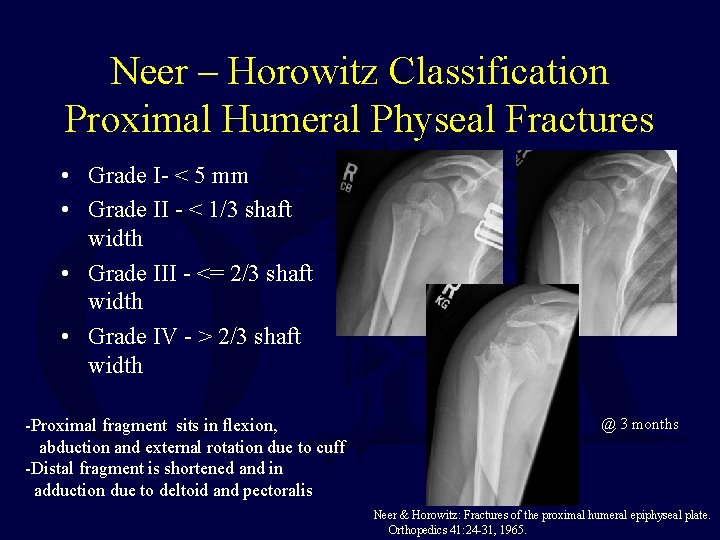 Neer – Horowitz Classification Proximal Humeral Physeal Fractures • Grade I- < 5 mm