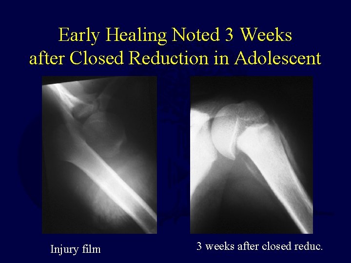 Early Healing Noted 3 Weeks after Closed Reduction in Adolescent Injury film 3 weeks