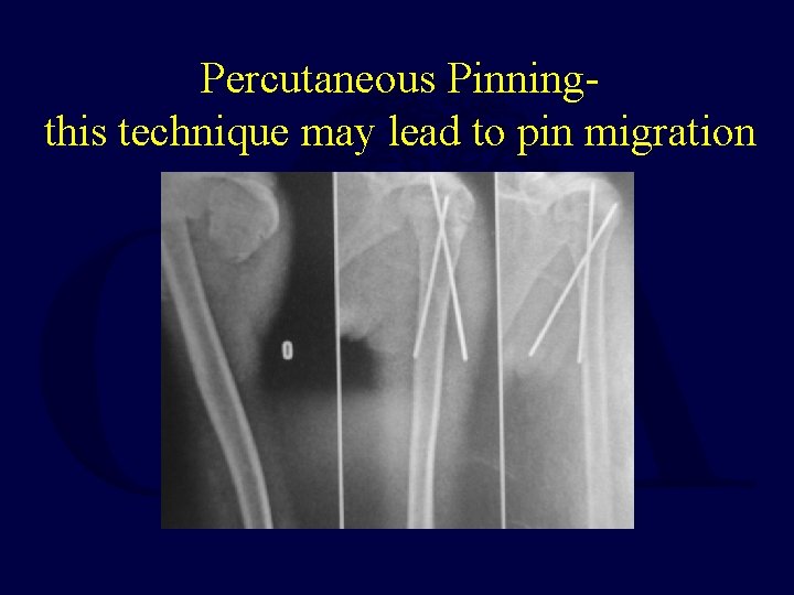 Percutaneous Pinningthis technique may lead to pin migration 
