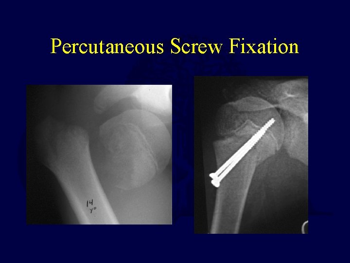 Percutaneous Screw Fixation 