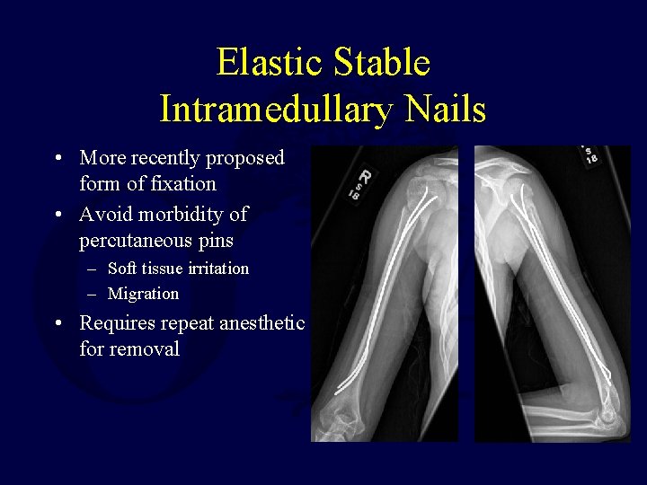 Elastic Stable Intramedullary Nails • More recently proposed form of fixation • Avoid morbidity