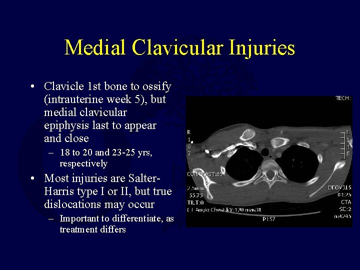 Medial Clavicular Injuries • Clavicle 1 st bone to ossify (intrauterine week 5), but
