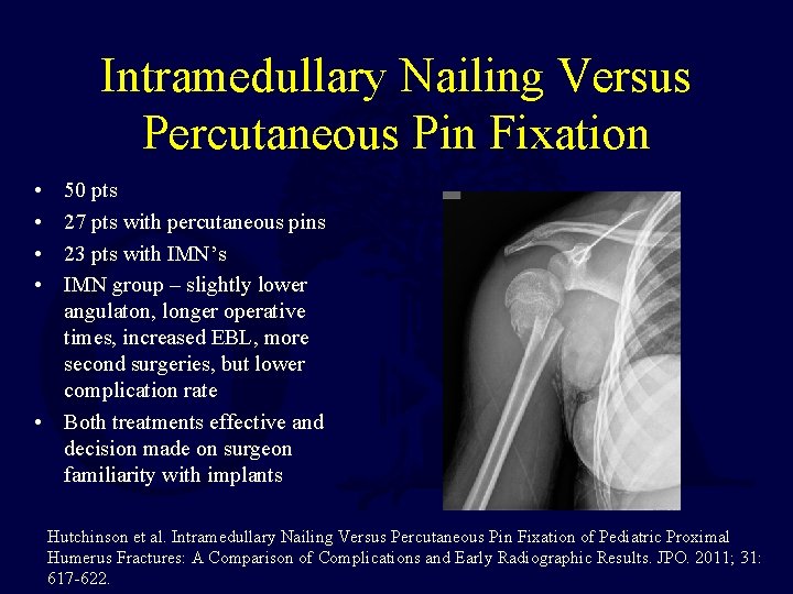 Intramedullary Nailing Versus Percutaneous Pin Fixation • • 50 pts 27 pts with percutaneous