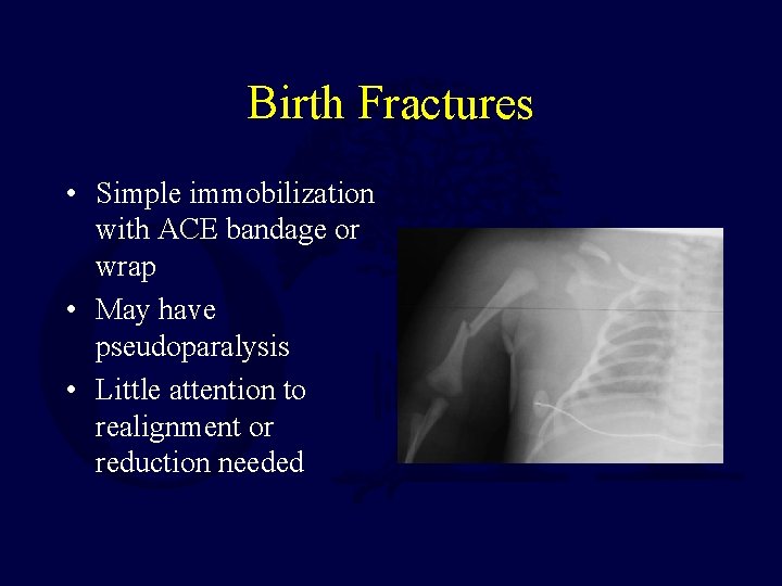 Birth Fractures • Simple immobilization with ACE bandage or wrap • May have pseudoparalysis