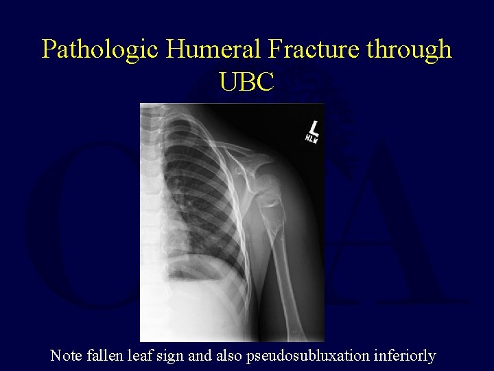 Pathologic Humeral Fracture through UBC Note fallen leaf sign and also pseudosubluxation inferiorly 