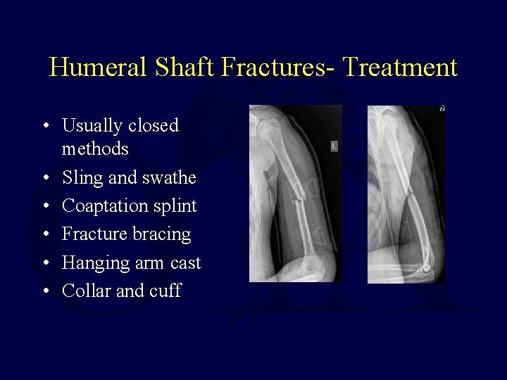 Humeral Shaft Fractures- Treatment • Usually closed methods • Sling and swathe • Coaptation