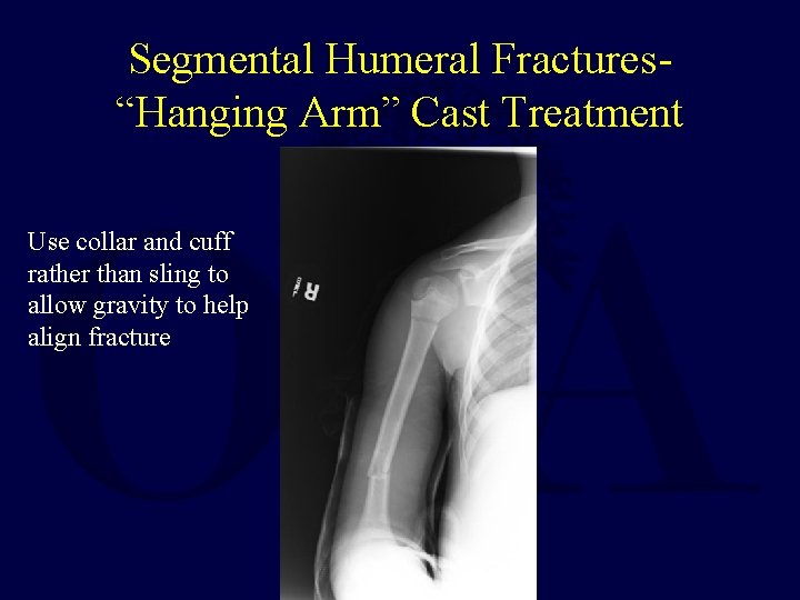 Segmental Humeral Fractures“Hanging Arm” Cast Treatment Use collar and cuff rather than sling to