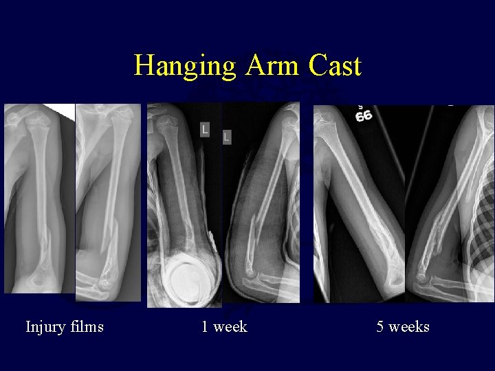 Hanging Arm Cast Injury films 1 week 5 weeks 