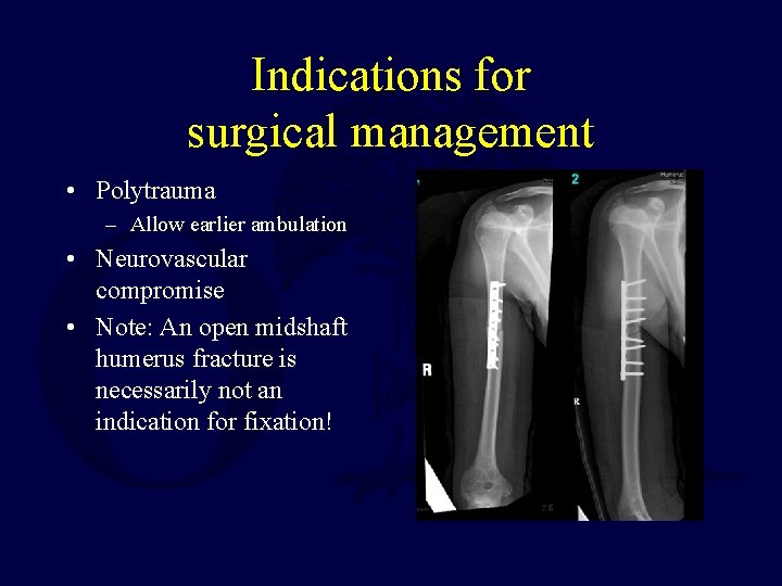 Indications for surgical management • Polytrauma – Allow earlier ambulation • Neurovascular compromise •