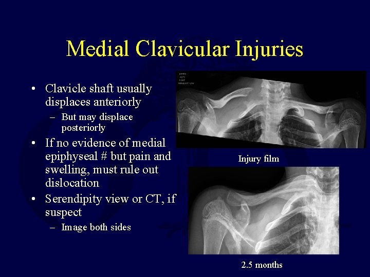 Medial Clavicular Injuries • Clavicle shaft usually displaces anteriorly – But may displace posteriorly