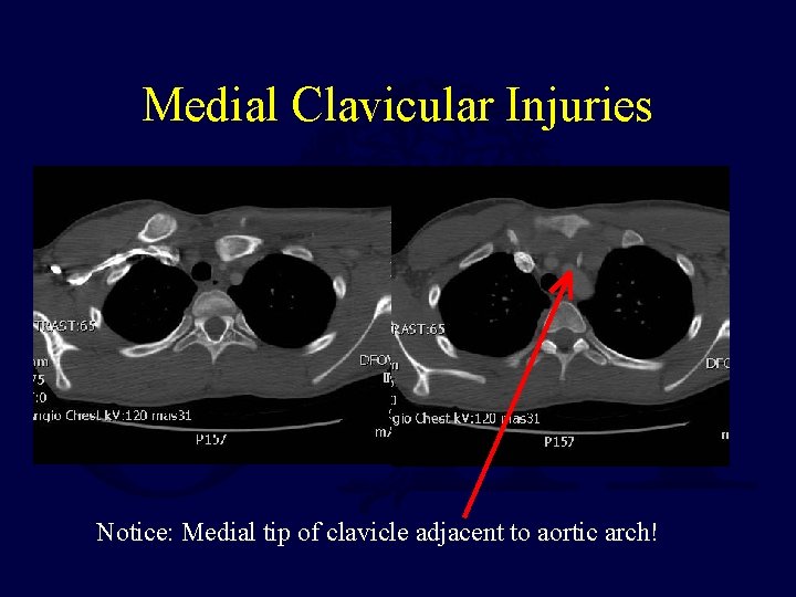Medial Clavicular Injuries Notice: Medial tip of clavicle adjacent to aortic arch! 