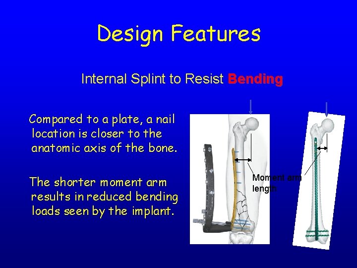 Design Features Internal Splint to Resist Bending Compared to a plate, a nail location