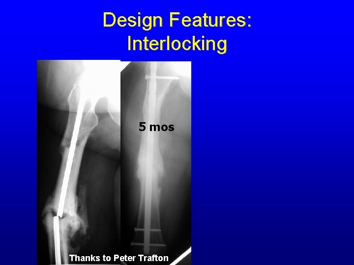 Design Features: Interlocking 5 mos Thanks to Peter Trafton 