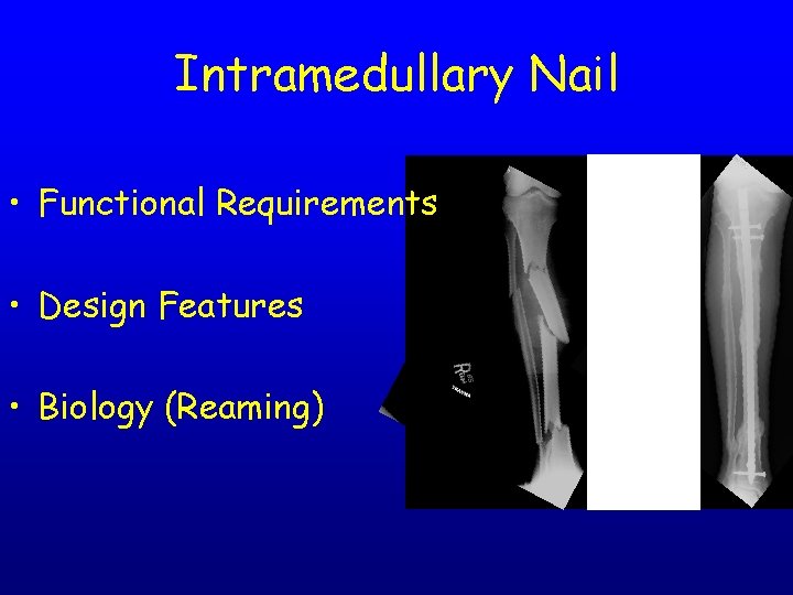 Intramedullary Nail • Functional Requirements • Design Features • Biology (Reaming) 