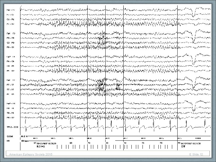 American Epilepsy Society 2015 E Slide 12 