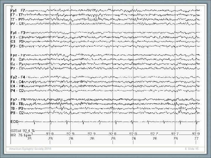 American Epilepsy Society 2015 E Slide 15 