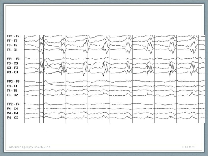 American Epilepsy Society 2015 E Slide 28 