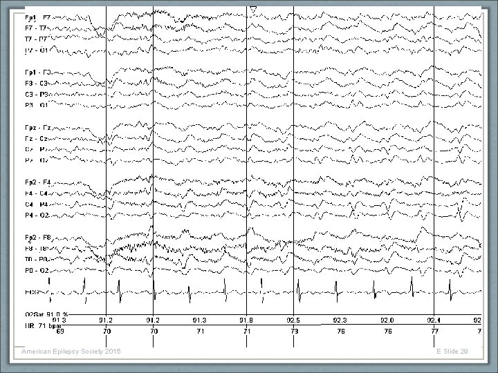 American Epilepsy Society 2015 E Slide 29 