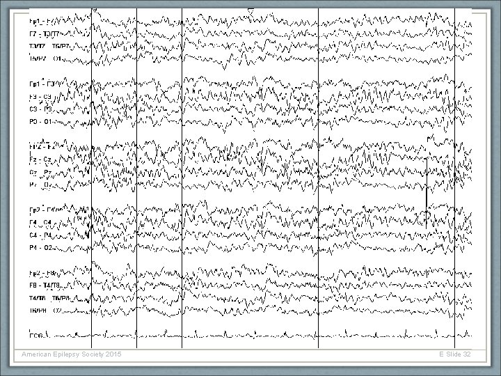 American Epilepsy Society 2015 E Slide 32 