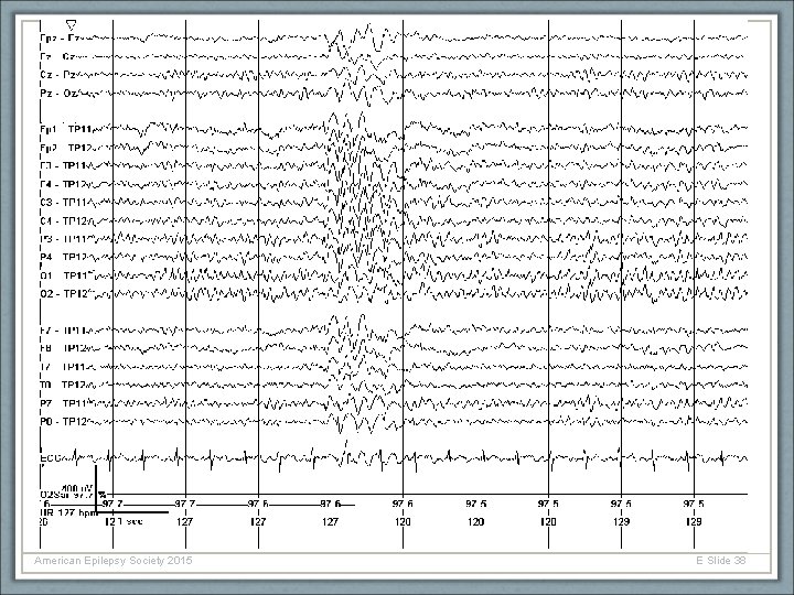 American Epilepsy Society 2015 E Slide 38 