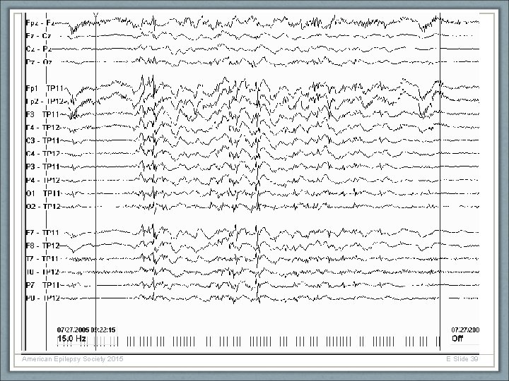 American Epilepsy Society 2015 E Slide 39 