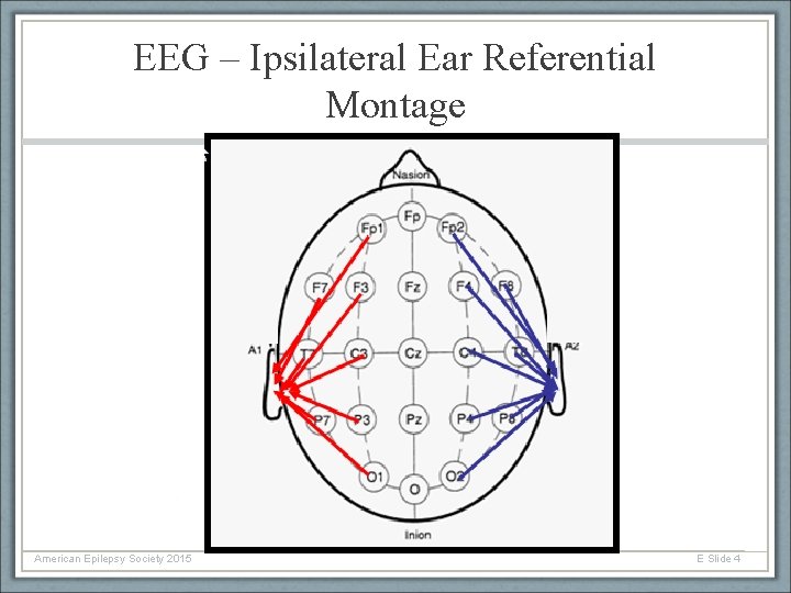 EEG – Ipsilateral Ear Referential Montage American Epilepsy Society 2015 E Slide 4 