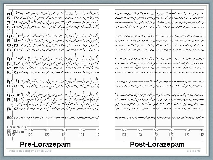 Pre-Lorazepam American Epilepsy Society 2015 Post-Lorazepam E Slide 45 