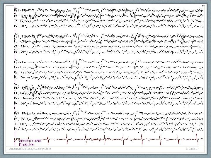 American Epilepsy Society 2015 E Slide 9 