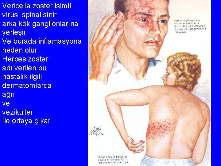 Vericella zoster isimli virus spinal sinir arka kök ganglionlarına yerleşir Ve burada inflamasyona neden