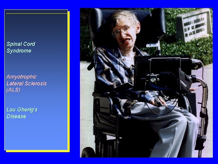Spinal Cord Syndrome Amyotrophic Lateral Sclerosis (ALS) Lou Gherig’s Disease 