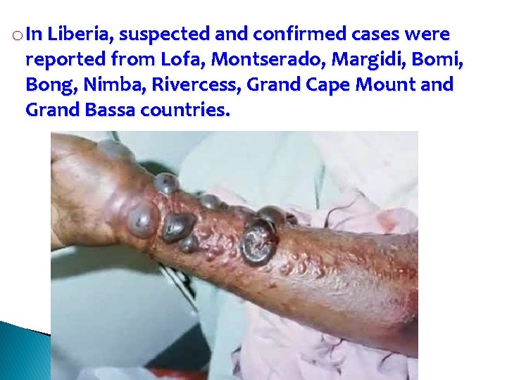 o In Liberia, suspected and confirmed cases were reported from Lofa, Montserado, Margidi, Bomi,