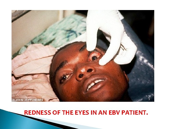 REDNESS OF THE EYES IN AN EBV PATIENT. 