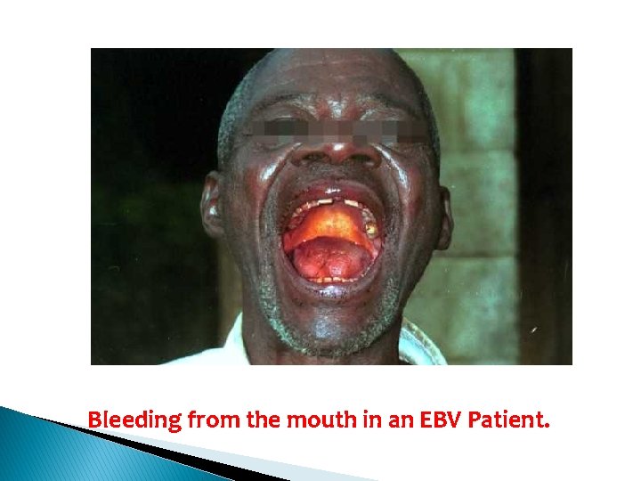 Bleeding from the mouth in an EBV Patient. 