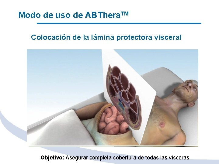 Modo de uso de ABThera. TM Colocación de la lámina protectora visceral Objetivo: Asegurar