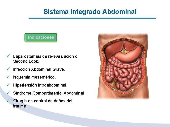 Sistema Integrado Abdominal ü Laparostomías de re-evaluación o Second Look. ü Infección Abdominal Grave.