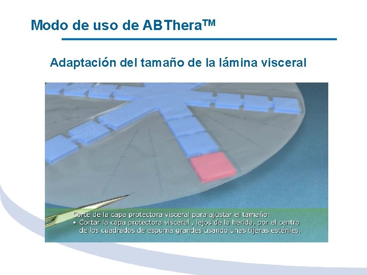 Modo de uso de ABThera. TM Adaptación del tamaño de la lámina visceral 