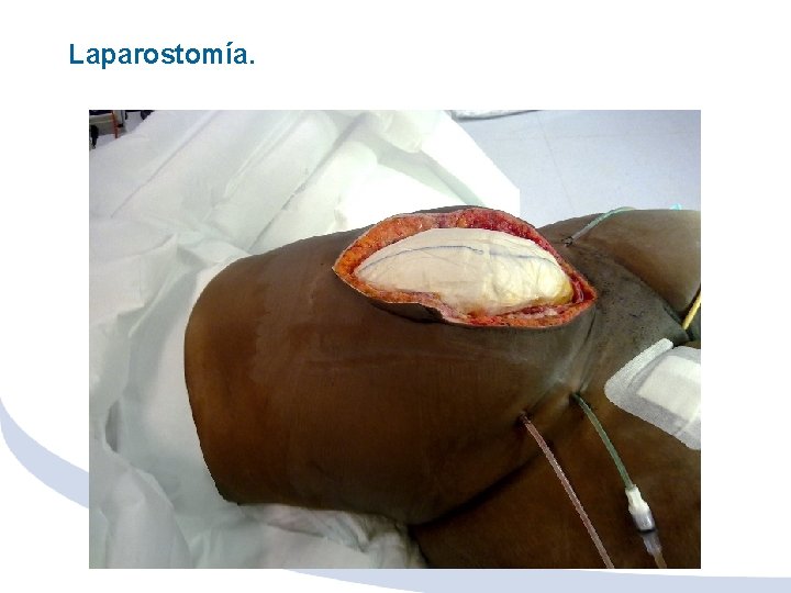 Laparostomía. 