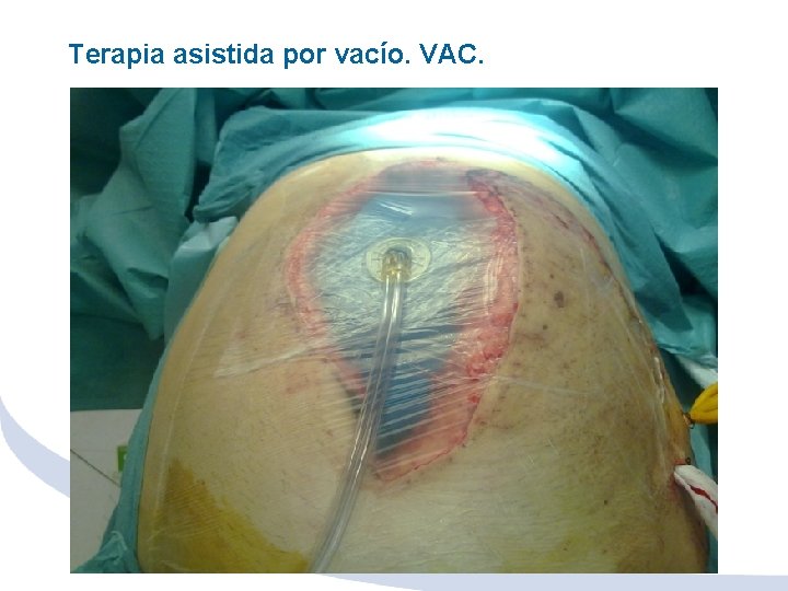 Terapia asistida por vacío. VAC. 