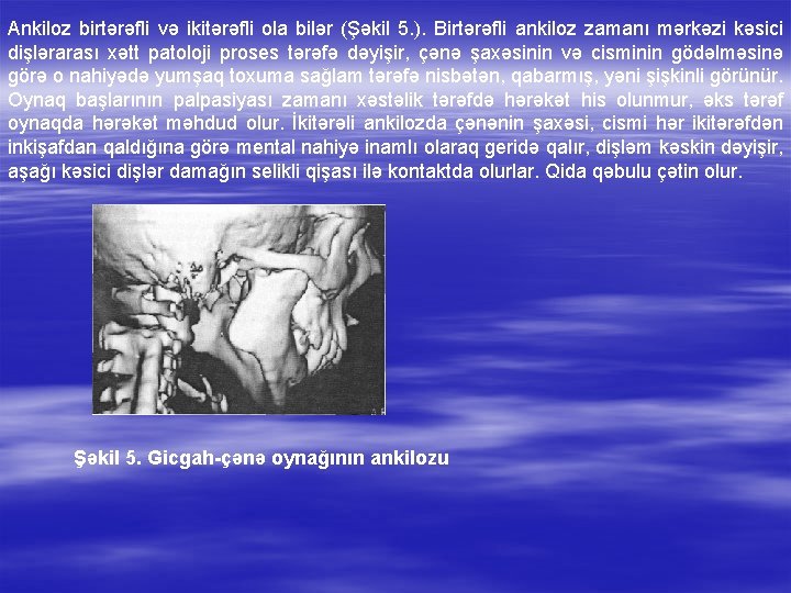 Ankiloz birtərəfli və ikitərəfli ola bilər (Şəkil 5. ). Birtərəfli ankiloz zamanı mərkəzi kəsici