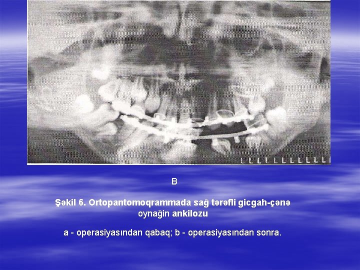 B Şəkil 6. Ortopantomoqrammada sağ tərəfli gicgah-çənə oynağin ankilozu a operasiyasından qabaq; b operasiyasından