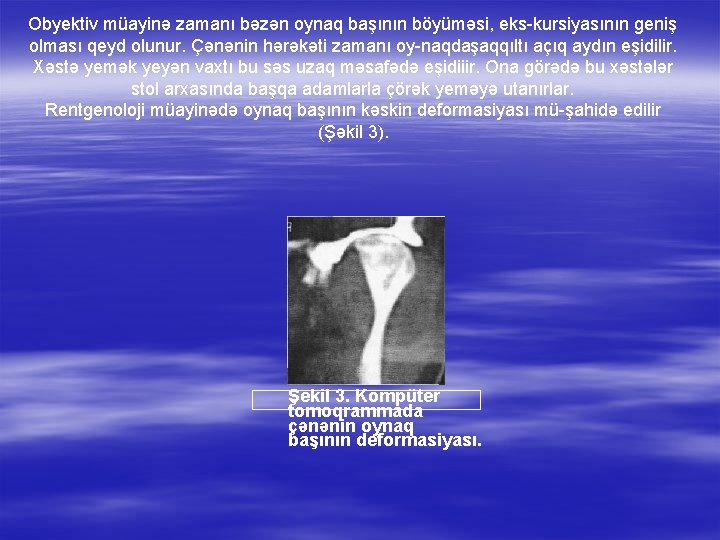 Obyektiv müayinə zamanı bəzən oynaq başının böyüməsi, eks kursiyasının geniş olması qeyd olunur. Çənənin