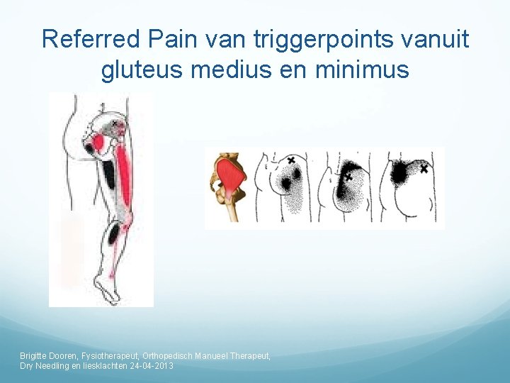 Referred Pain van triggerpoints vanuit gluteus medius en minimus Brigitte Dooren, Fysiotherapeut, Orthopedisch Manueel