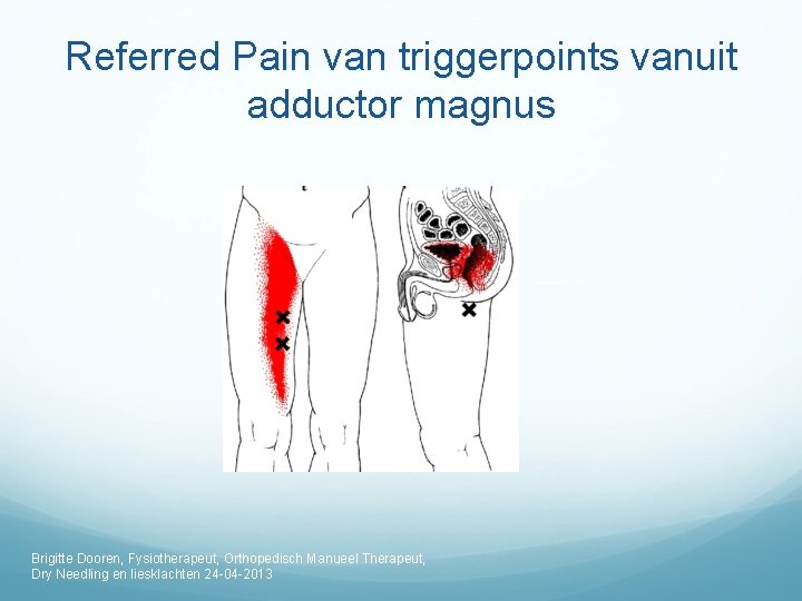 Referred Pain van triggerpoints vanuit adductor magnus Brigitte Dooren, Fysiotherapeut, Orthopedisch Manueel Therapeut, Dry