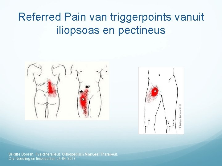 Referred Pain van triggerpoints vanuit iliopsoas en pectineus Brigitte Dooren, Fysiotherapeut, Orthopedisch Manueel Therapeut,